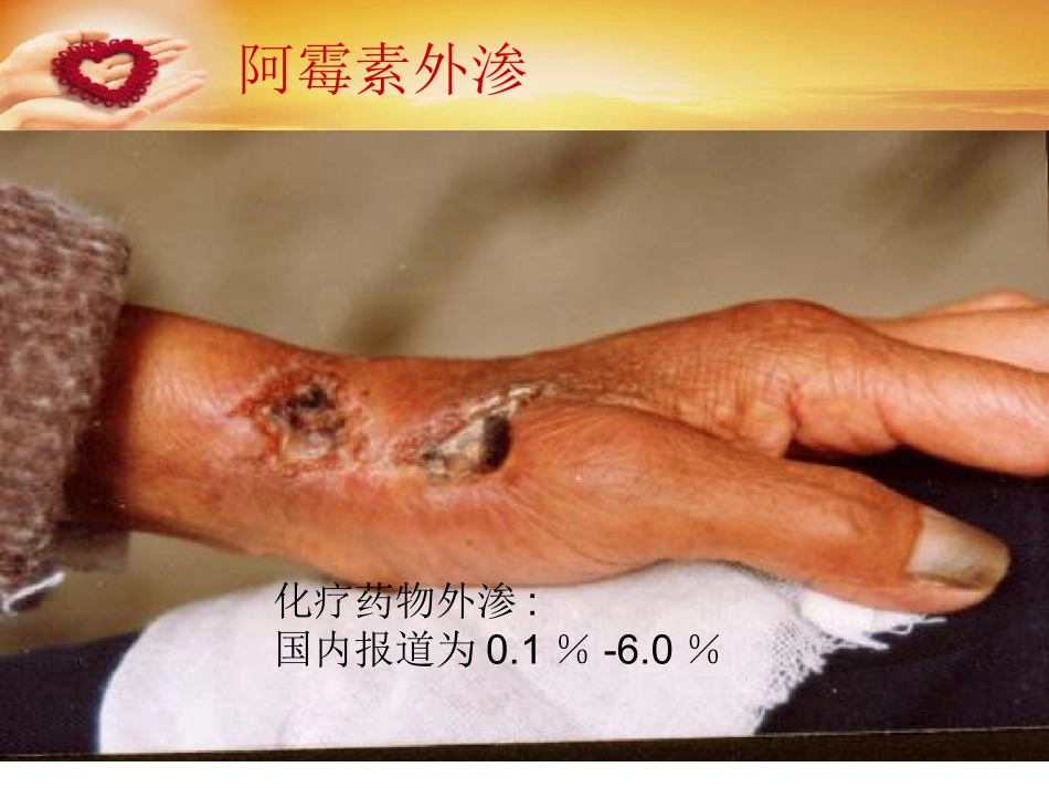 主动静脉治疗_第2页