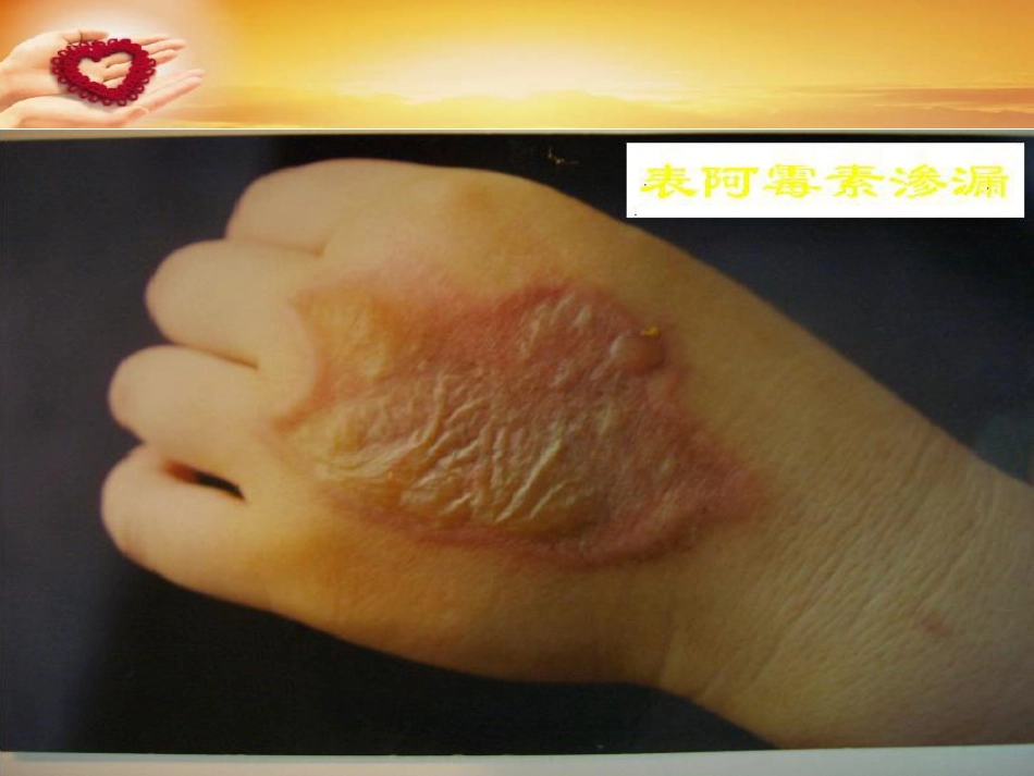 主动静脉治疗_第3页