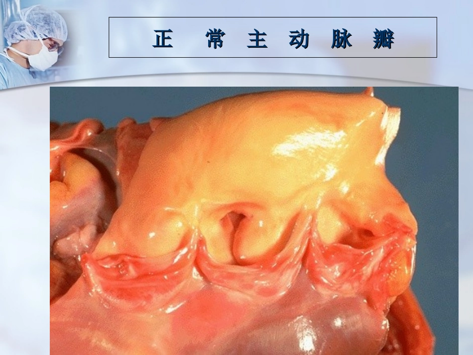 主动脉瓣病主动脉瓣狭窄_第2页