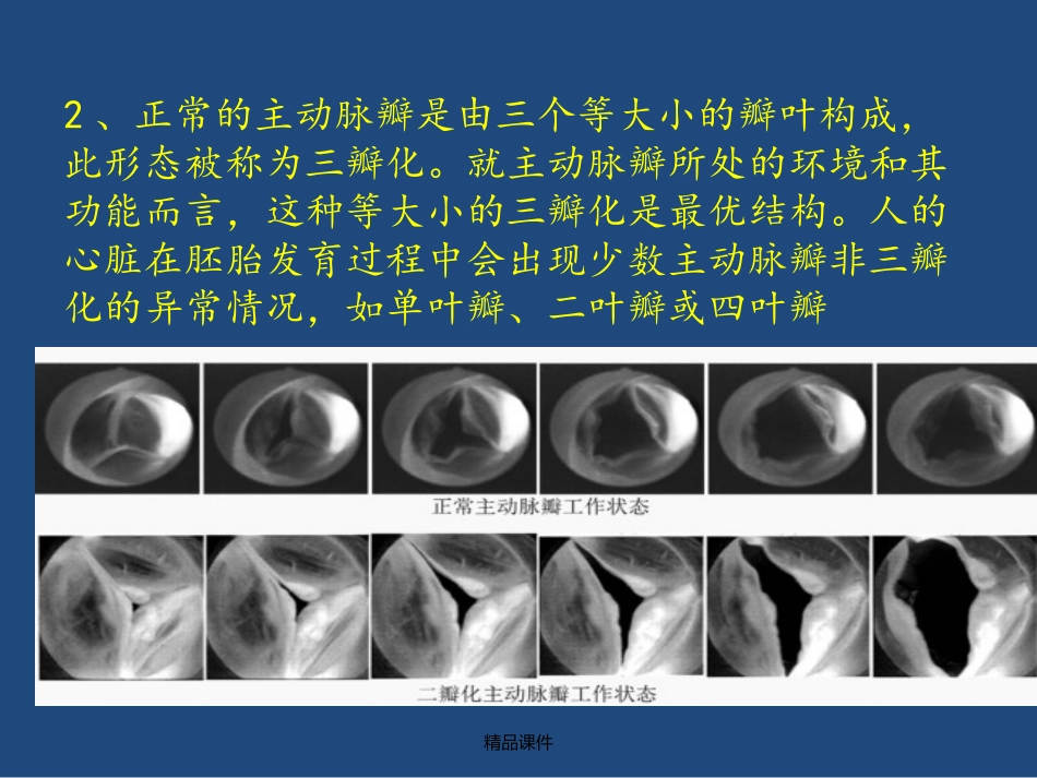 主动脉瓣狭窄AS_第3页