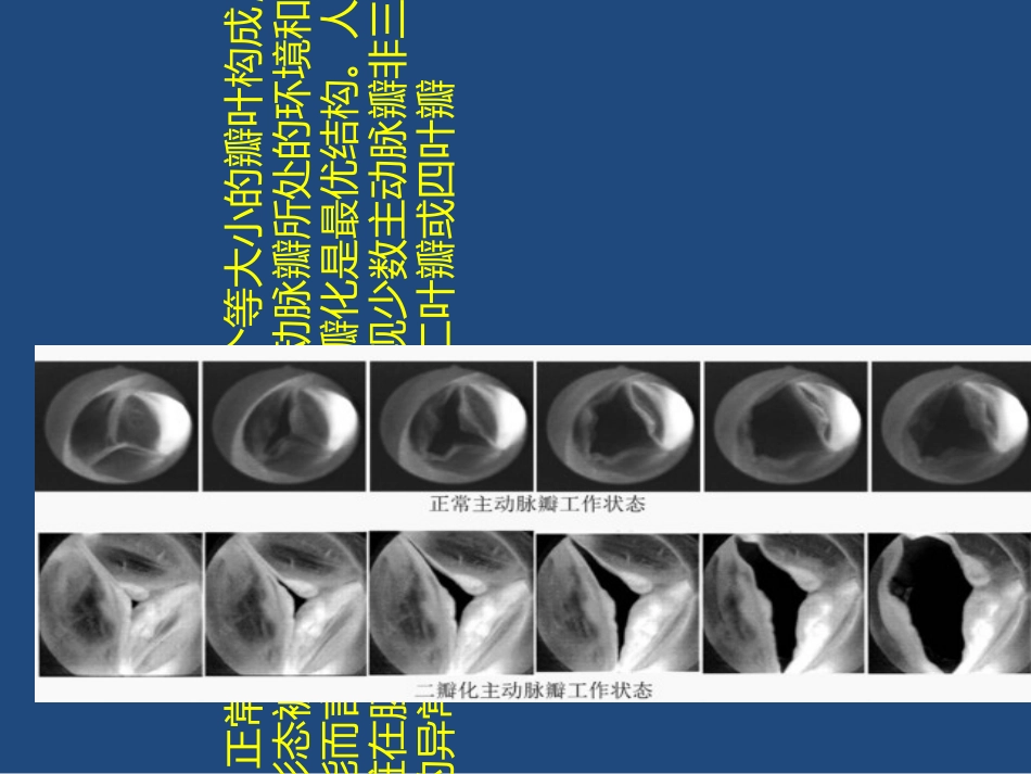 主动脉瓣狭窄讲义_第3页