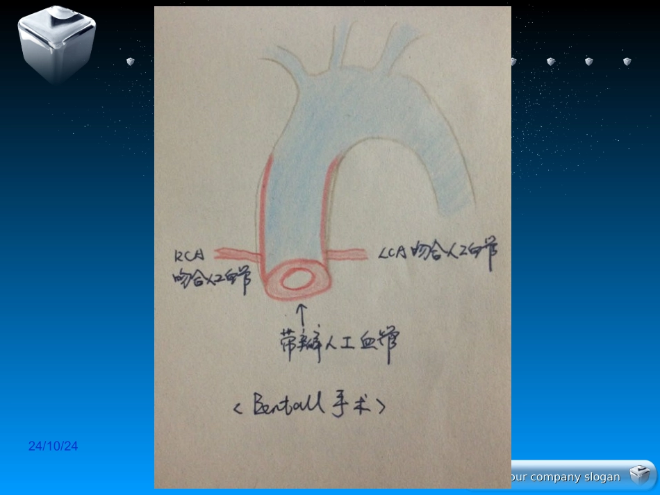 主动脉瓣置换升主动脉置换术护理查房_第3页