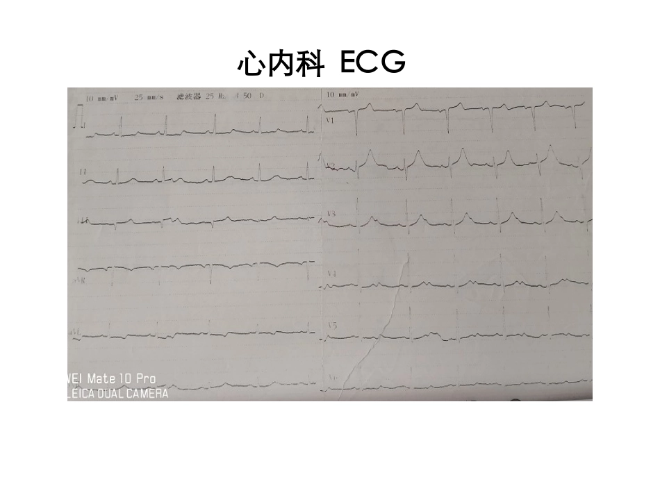 主动脉夹层并急性心肌梗死病例分享_第3页