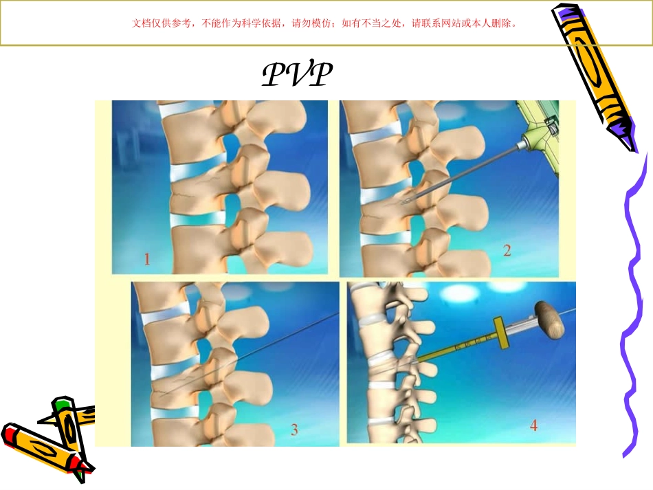 椎体成形术手术步骤及注意事项课件_第2页