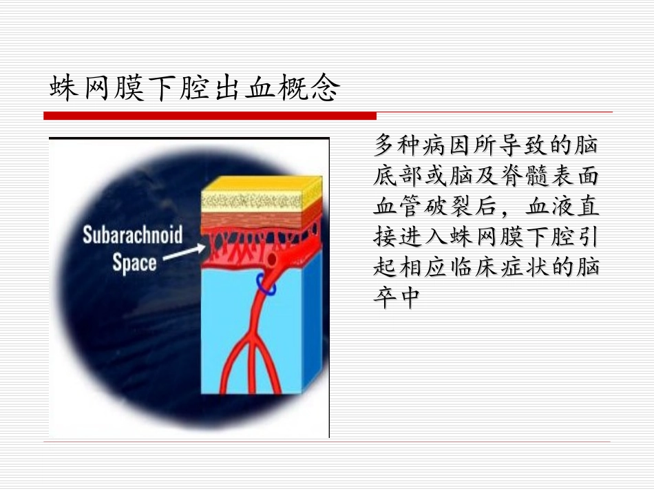 自发性蛛网膜下腔出血的规范化治疗谭华桥_第2页