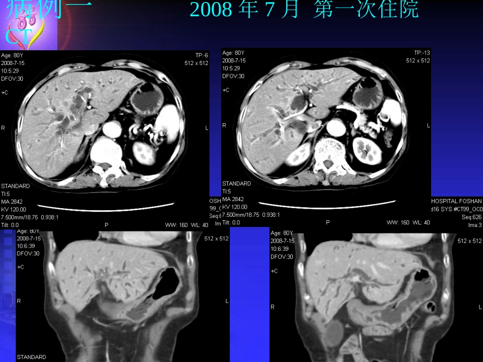 ERCP案例分析_第3页