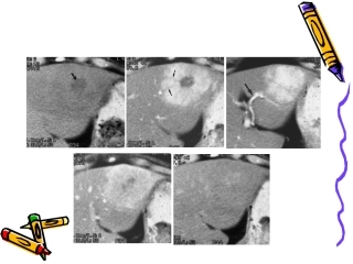 fnh的影像诊断及鉴别诊断