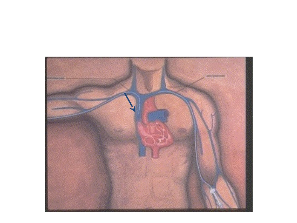 PICC导管临床应用研究报告_第3页
