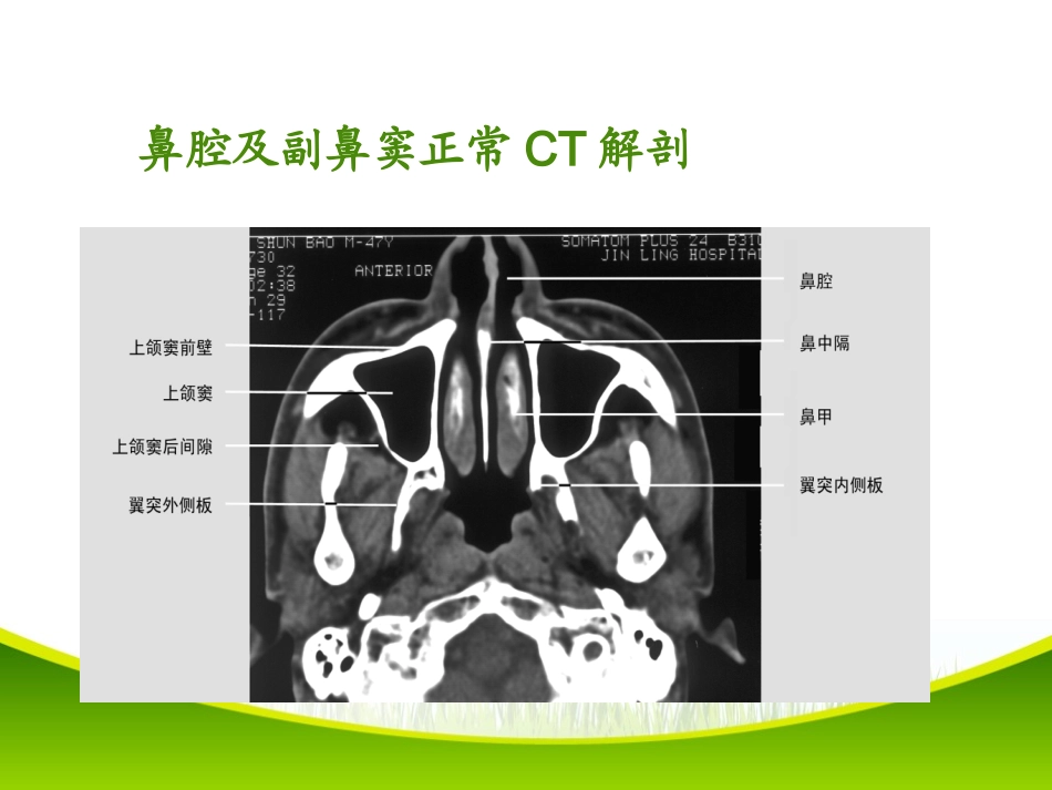 鼻和鼻窦病变CT诊断_第2页