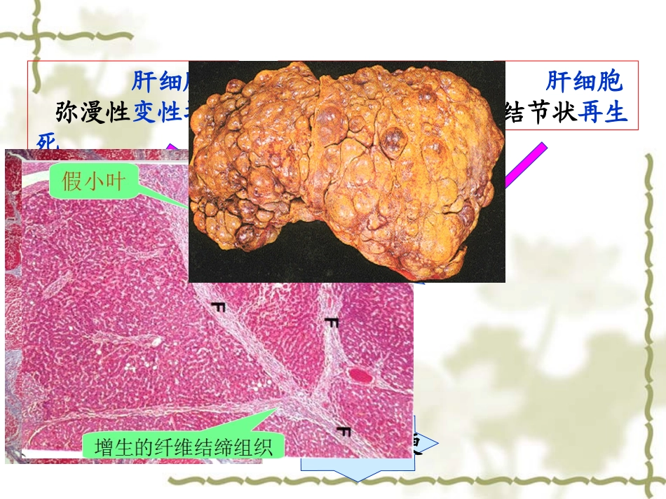 病理学肝硬化_第2页