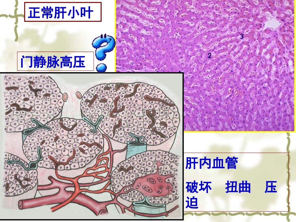 病理学肝硬化_第3页