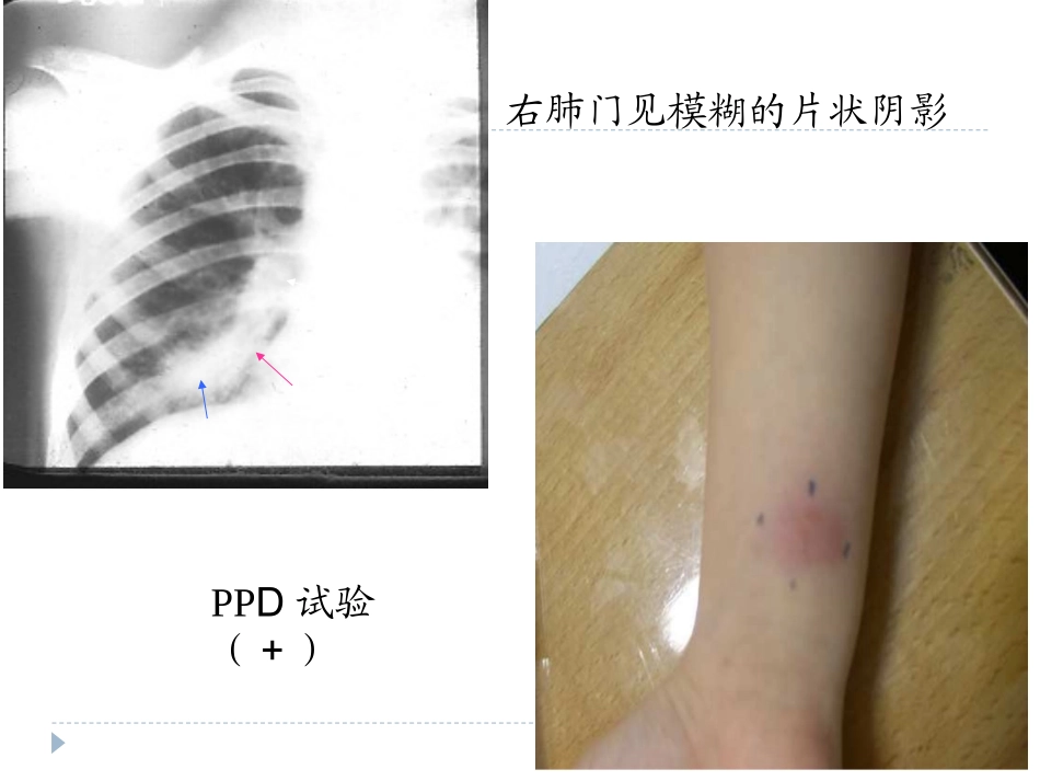 病理学结核病_第3页