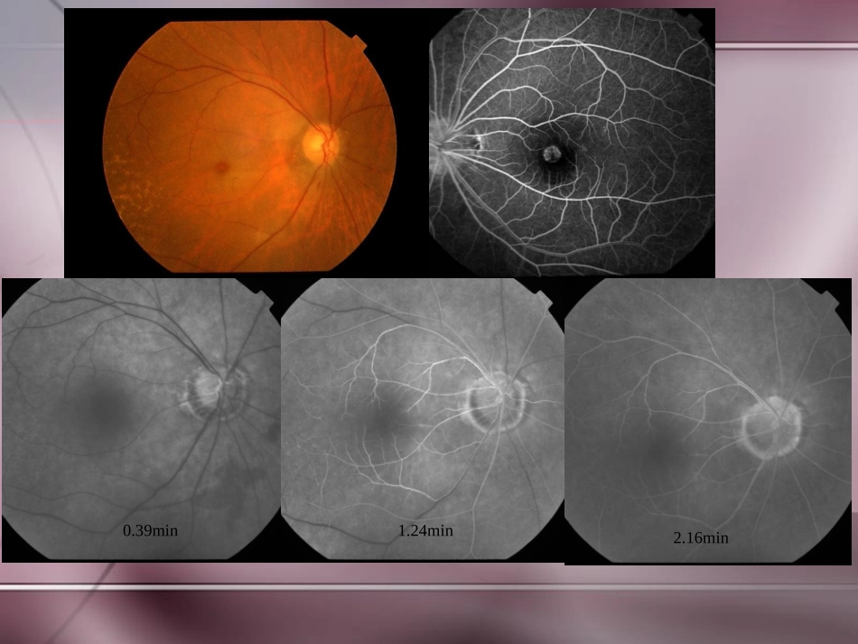 常见眼底病诊治_第3页