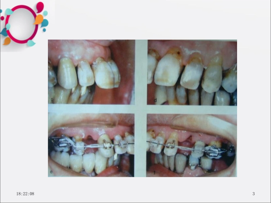 成人正畸课件_第3页