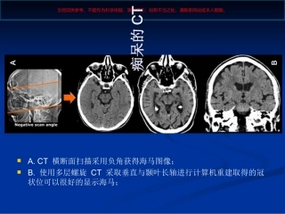 痴呆的影像学课件