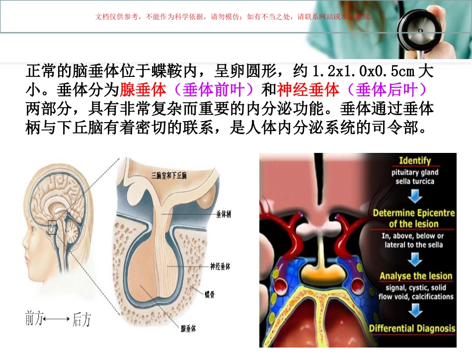 垂体瘤护理查房课件_第1页