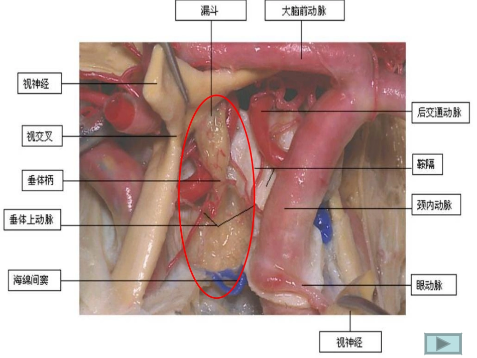 垂体瘤护理查房课件_第2页