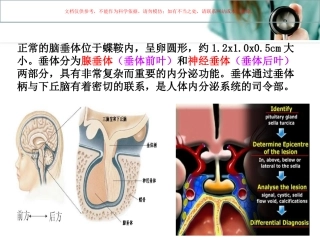 垂体瘤护理查房课件