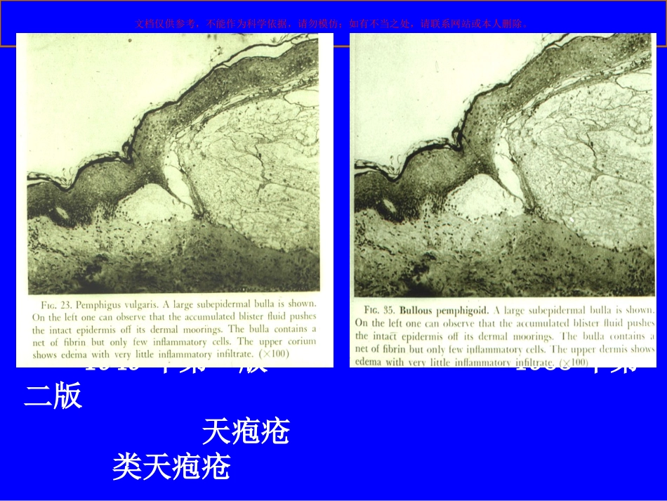 大疱性皮肤病课件_第3页