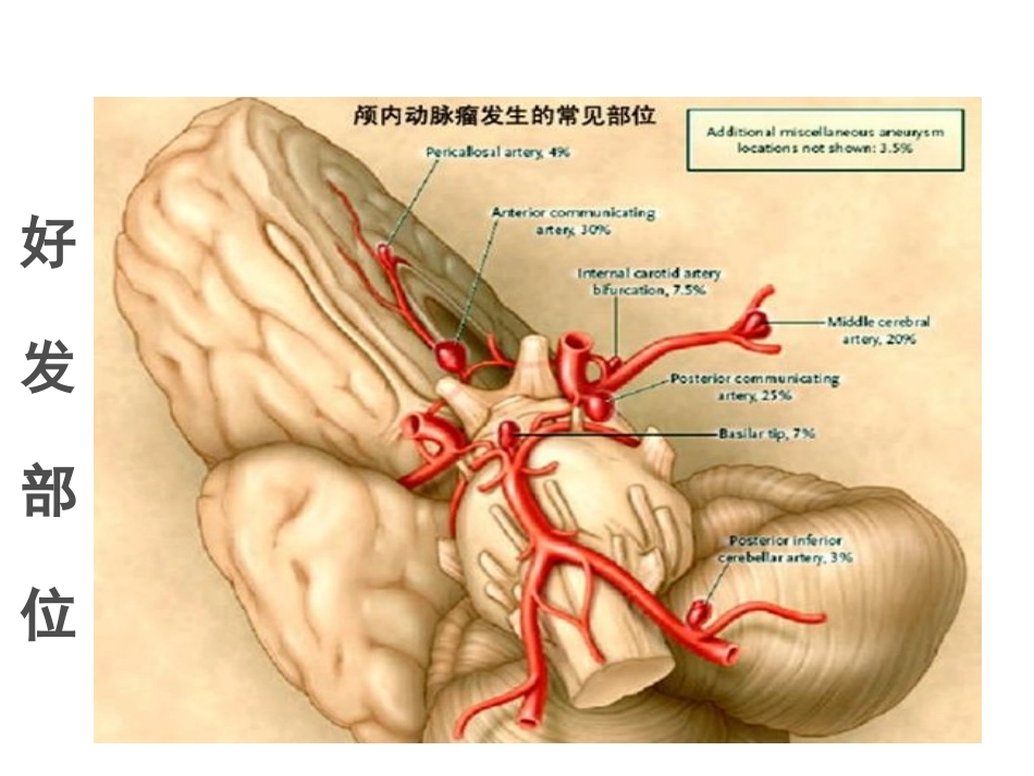 动脉瘤的介入治疗_第3页
