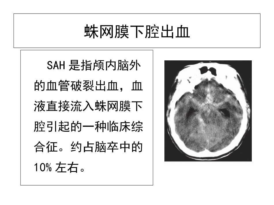 动脉瘤性蛛网膜下腔出血诊治课件_第3页