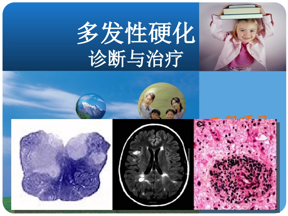 多发性硬化的诊断与治疗_第1页