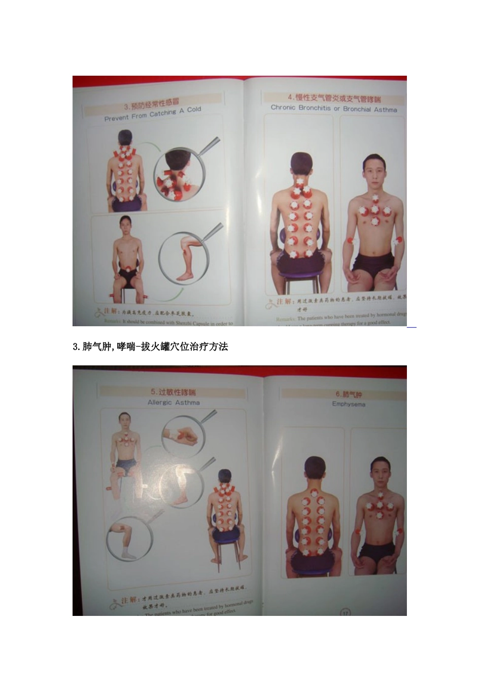 拔火罐穴位图解杂谈_第2页