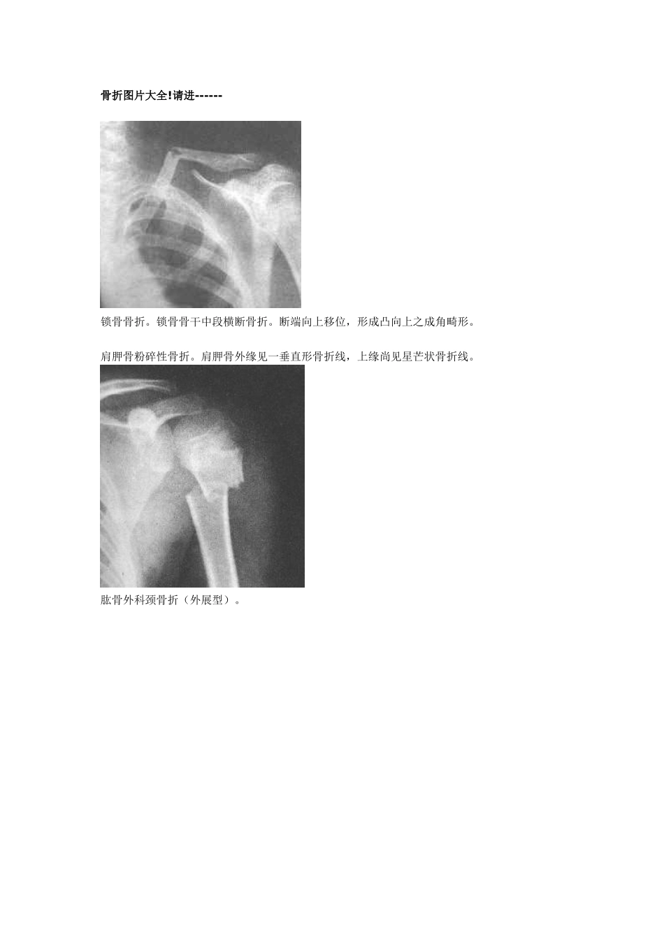 骨折图片大全_第1页