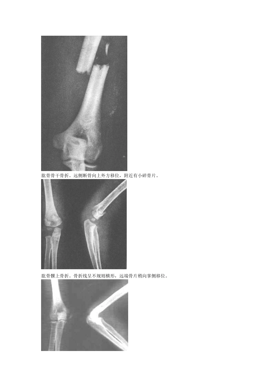 骨折图片大全_第2页