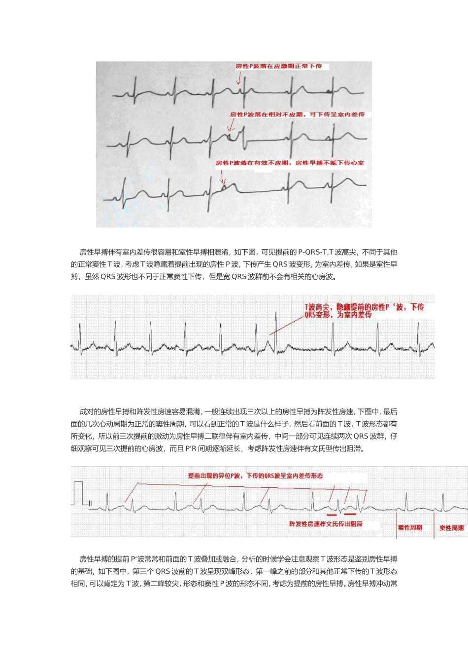早搏的诊断和鉴别诊断_第3页