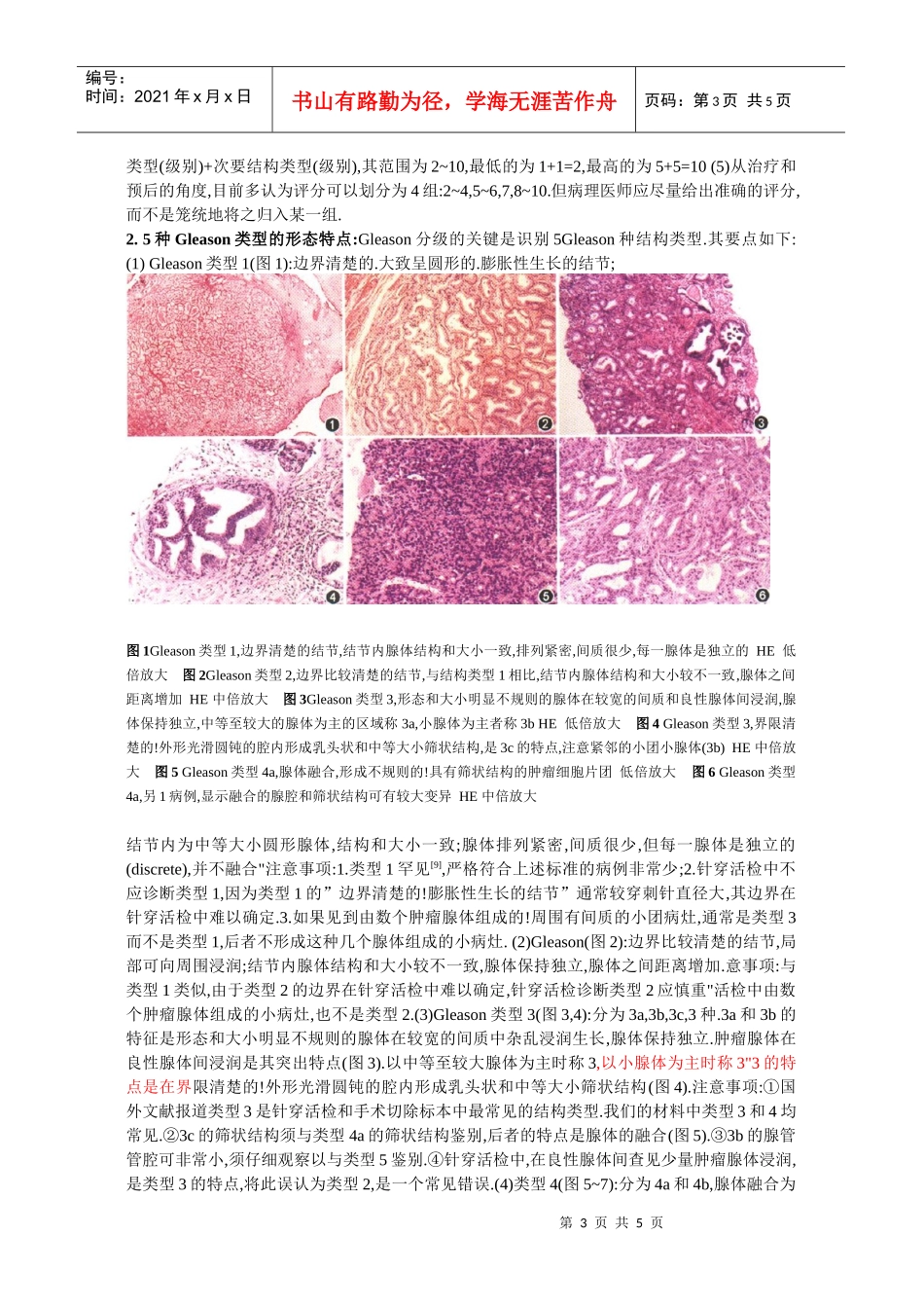 前列腺癌的病理诊断及Gleason分级_第3页
