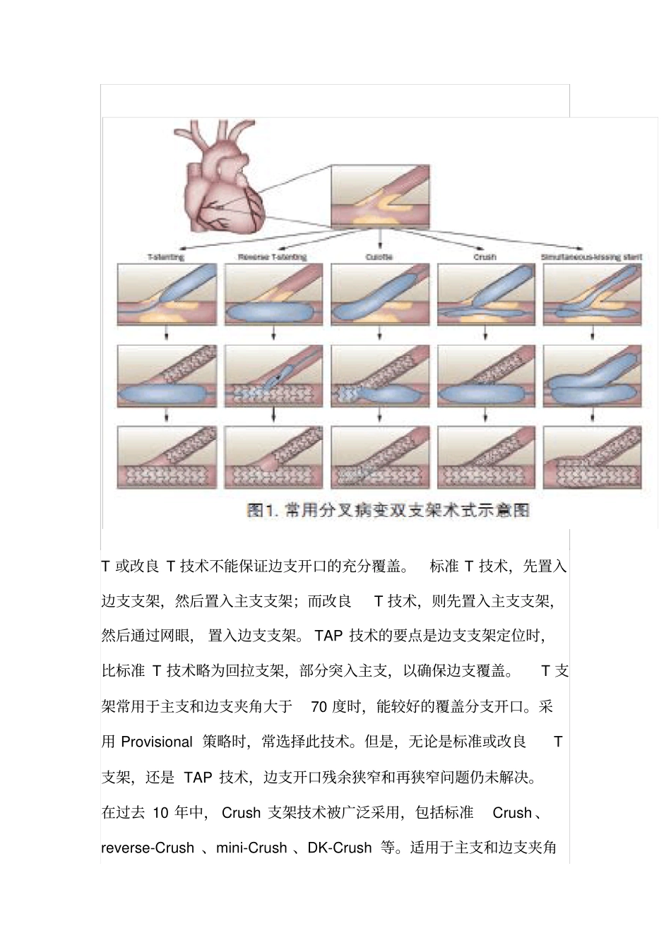 -冠脉分叉病变支架术式_第2页