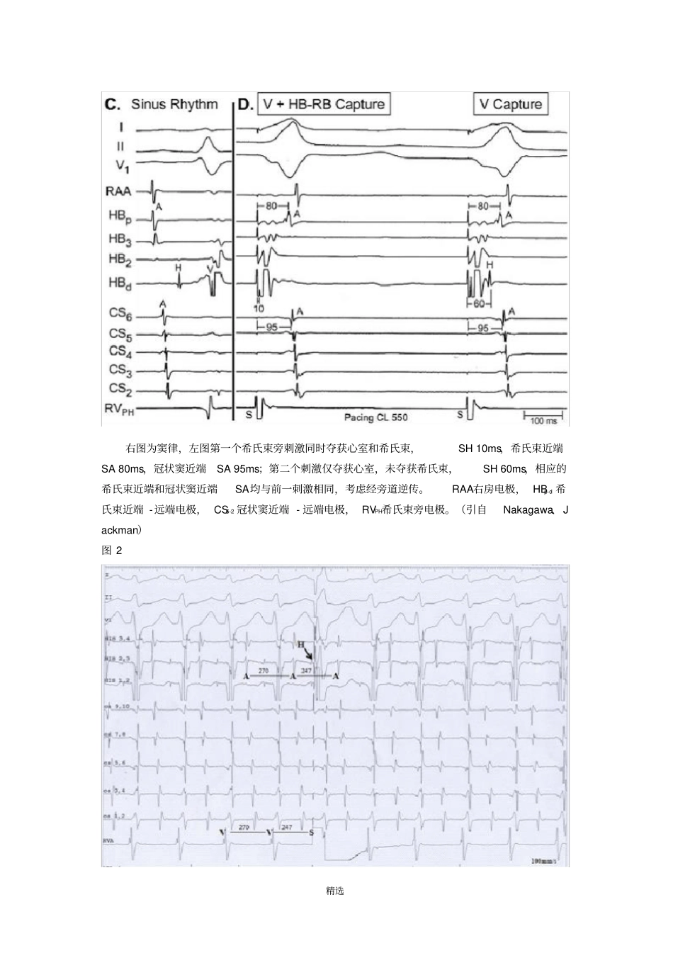 室上性心动过速鉴别诊断的常用心内电生理程序刺激方法_第3页