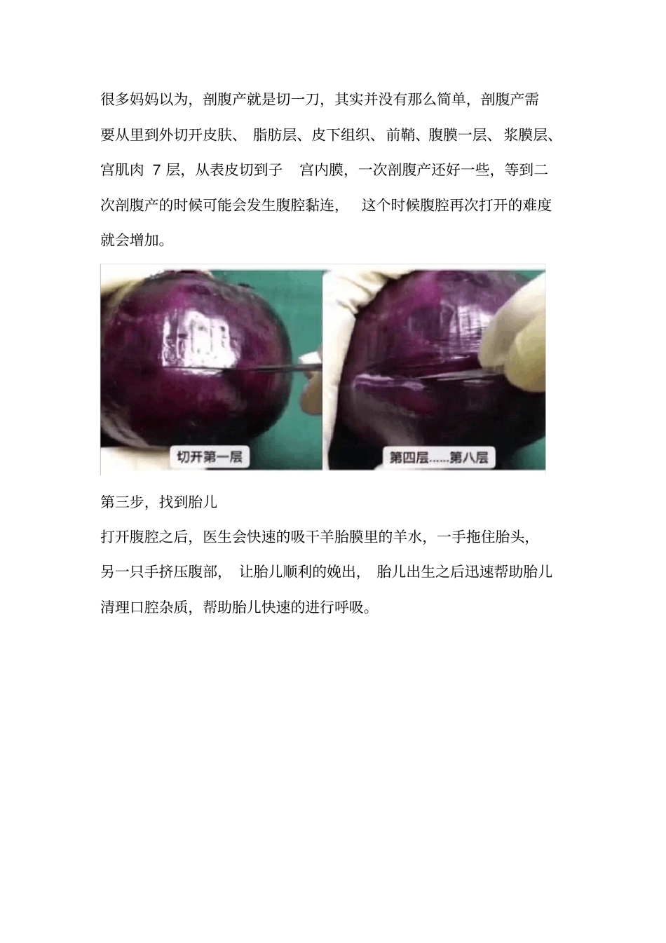 剖腹产缝几层一个洋葱让你了解清楚_第2页