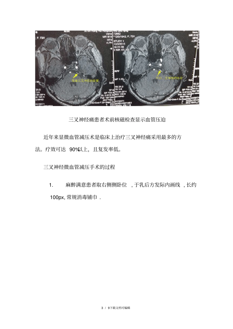 微血管减压手术治疗三叉神经痛的过程_第3页