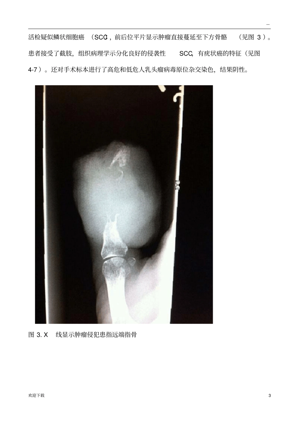 手指肿瘤鉴别诊断_第3页