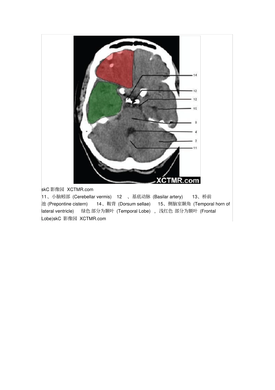 (完整版)颅脑CT解剖_第3页