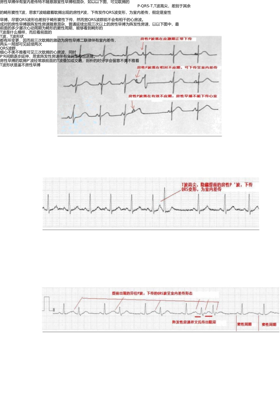 早搏的诊断和鉴别诊断 _第3页