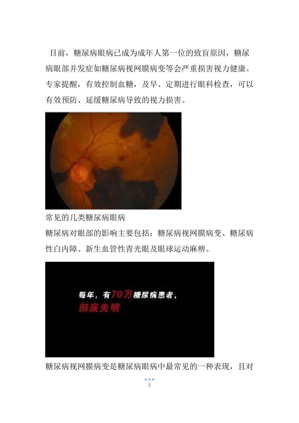 糖尿病会导致眼睛失明,视力模糊是前期征兆!_第2页