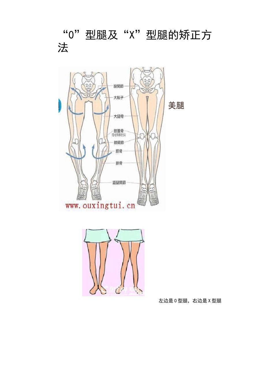 O型腿和X型腿的矫正方法_第1页