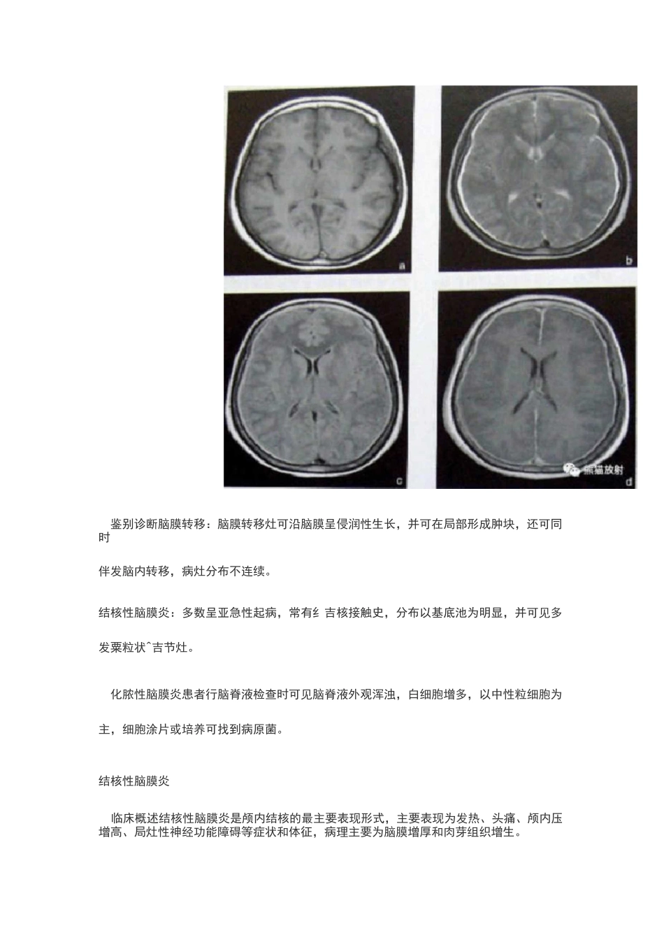 7种颅内感染_第2页