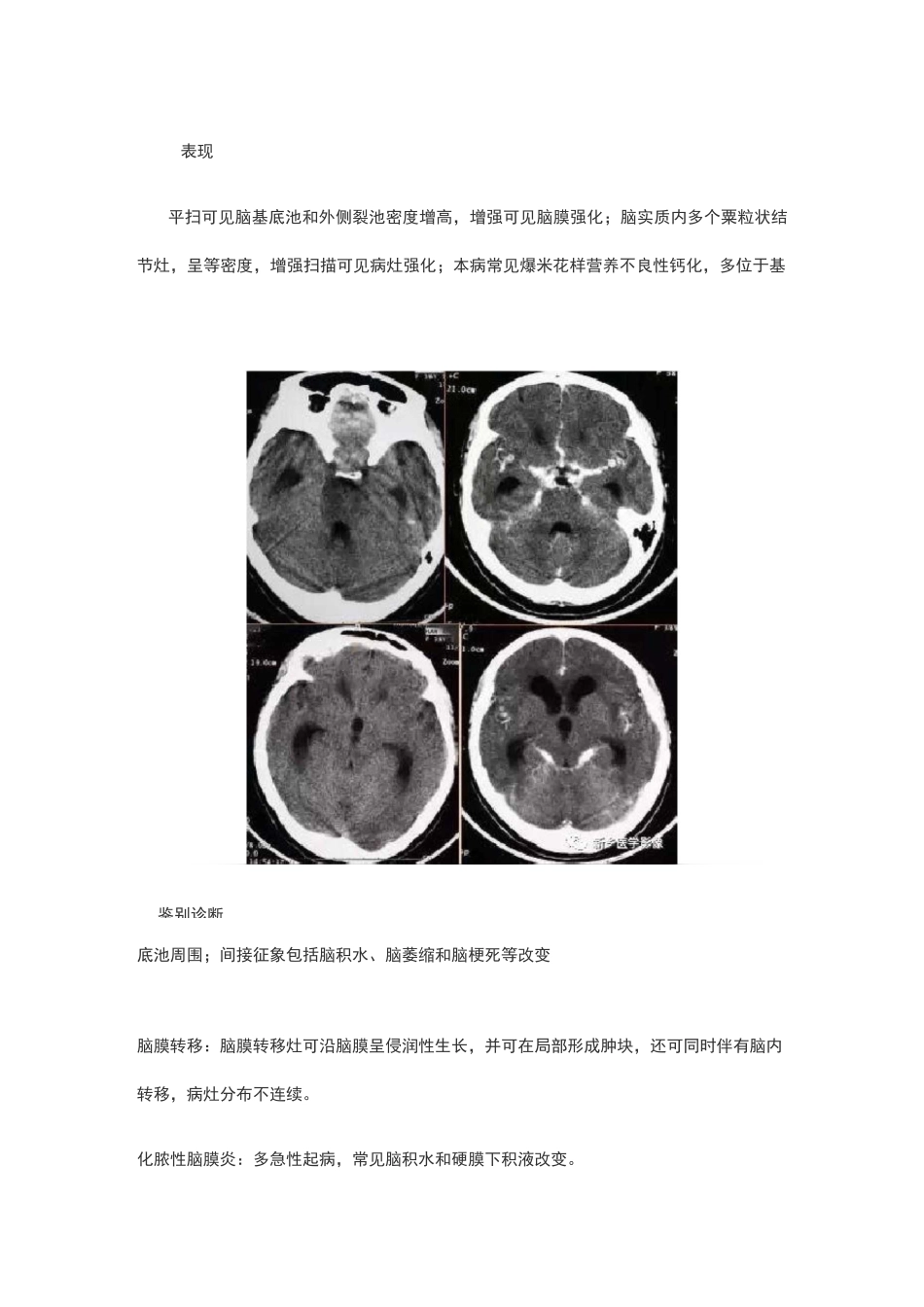 7种颅内感染_第3页