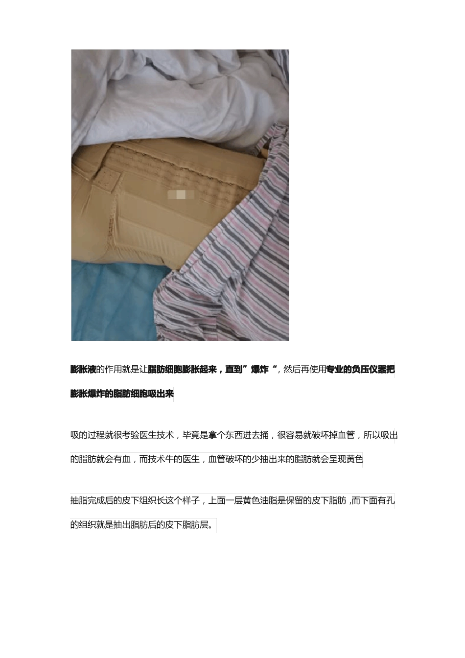 抽脂对身体有什么伤害,抽脂肪肚子多久能恢复正常_第2页