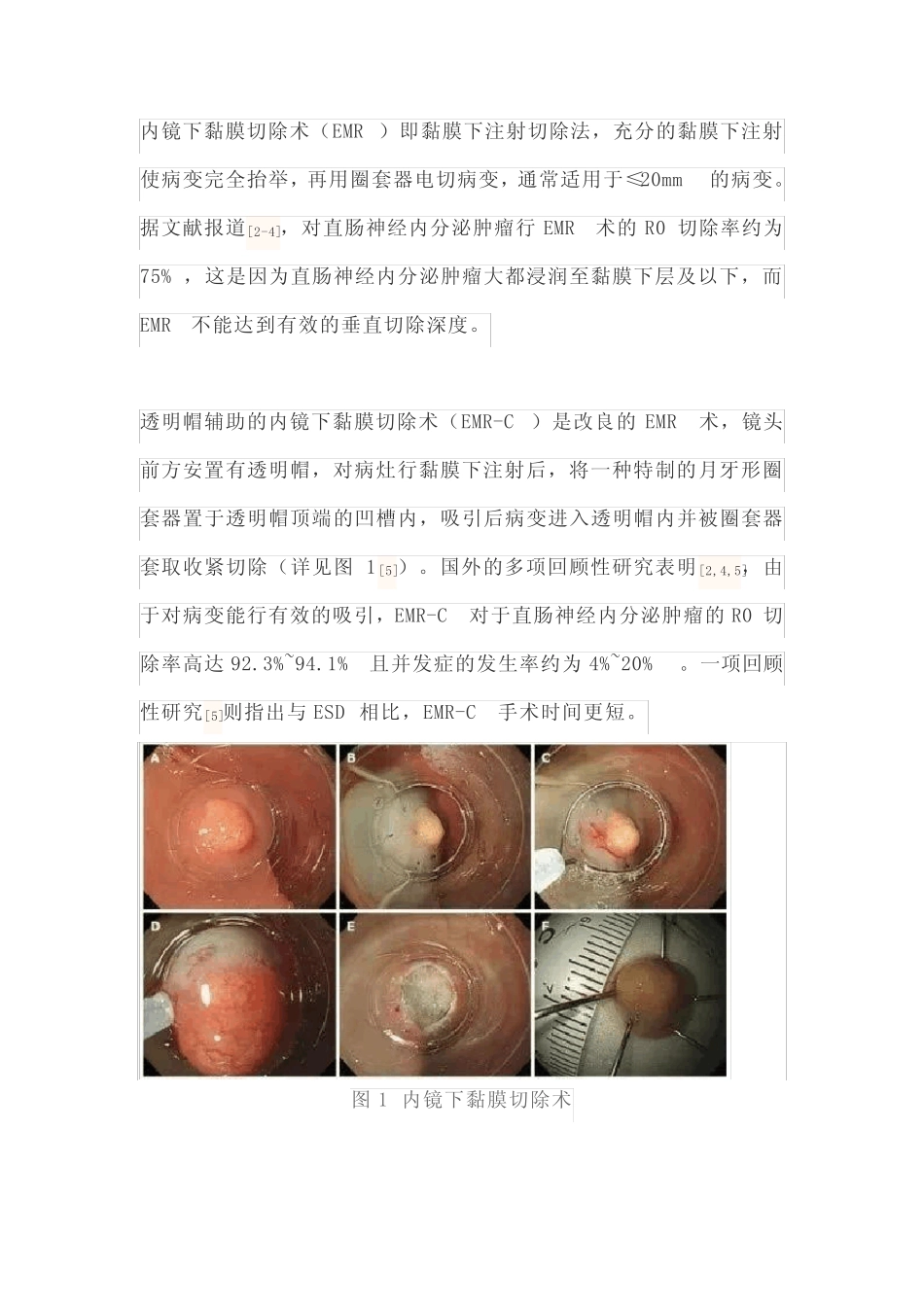 2021直肠神经内分泌肿瘤内镜下诊治进展(全文) _第2页