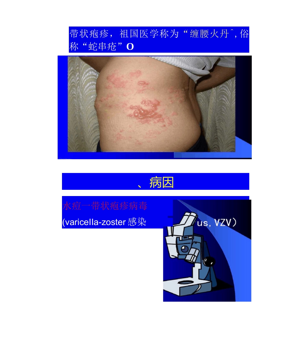 带状疱疹的中医诊断及治疗_第2页