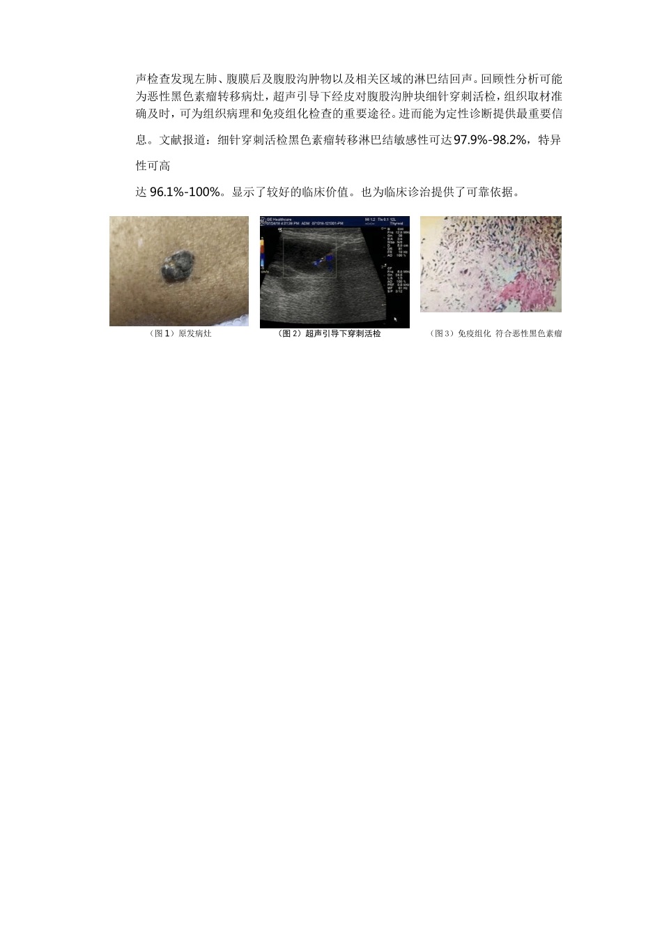 恶性黑色素瘤转移超声表现1例_第2页