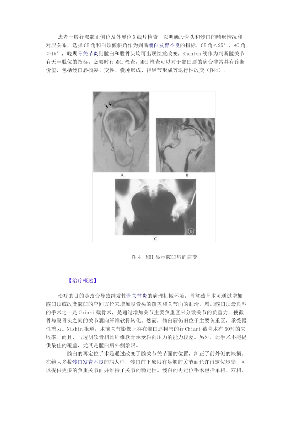 髋臼发育不良_第3页