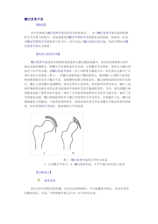 髋臼发育不良