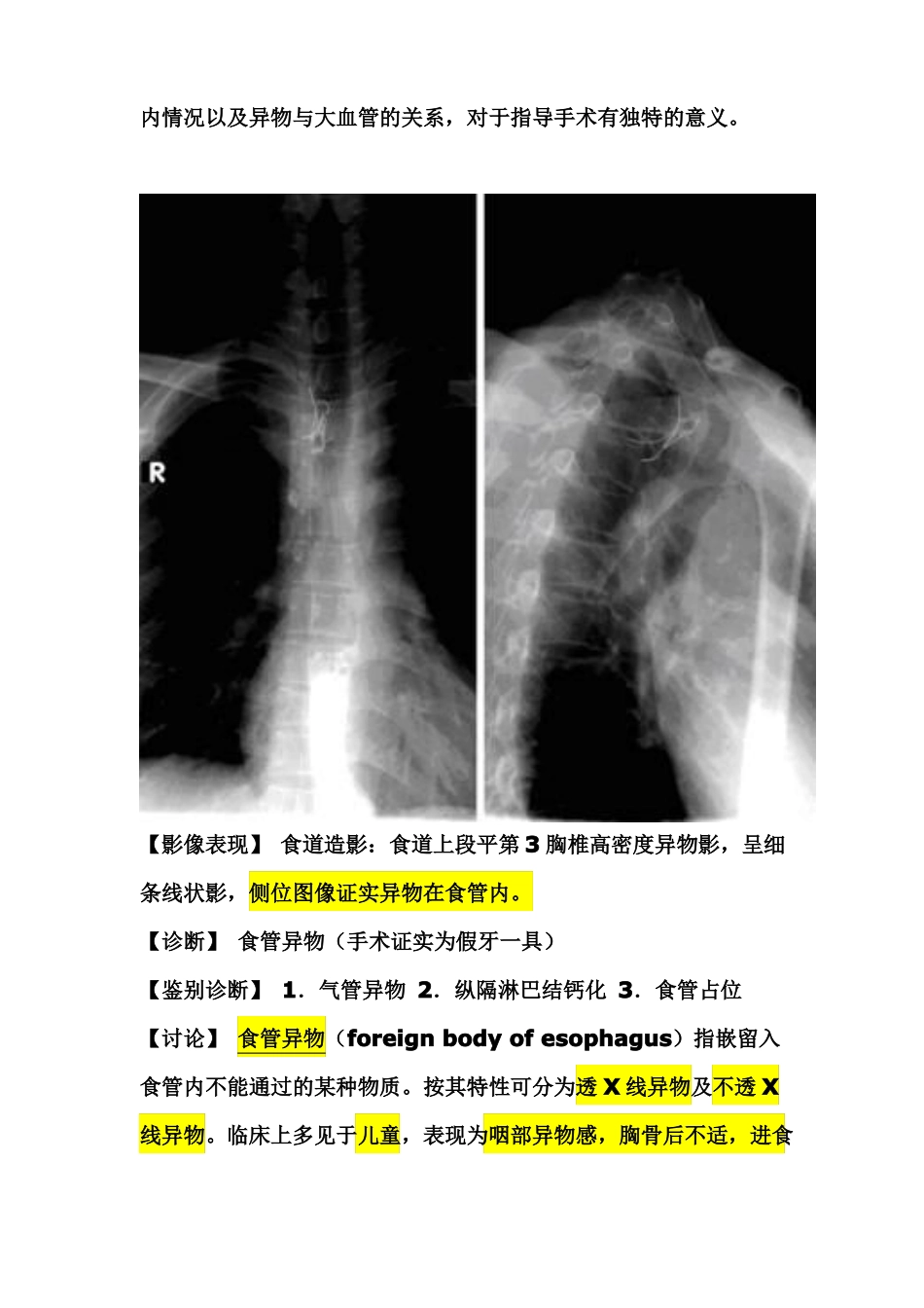 食管异物和气管异物鉴别诊断_第2页