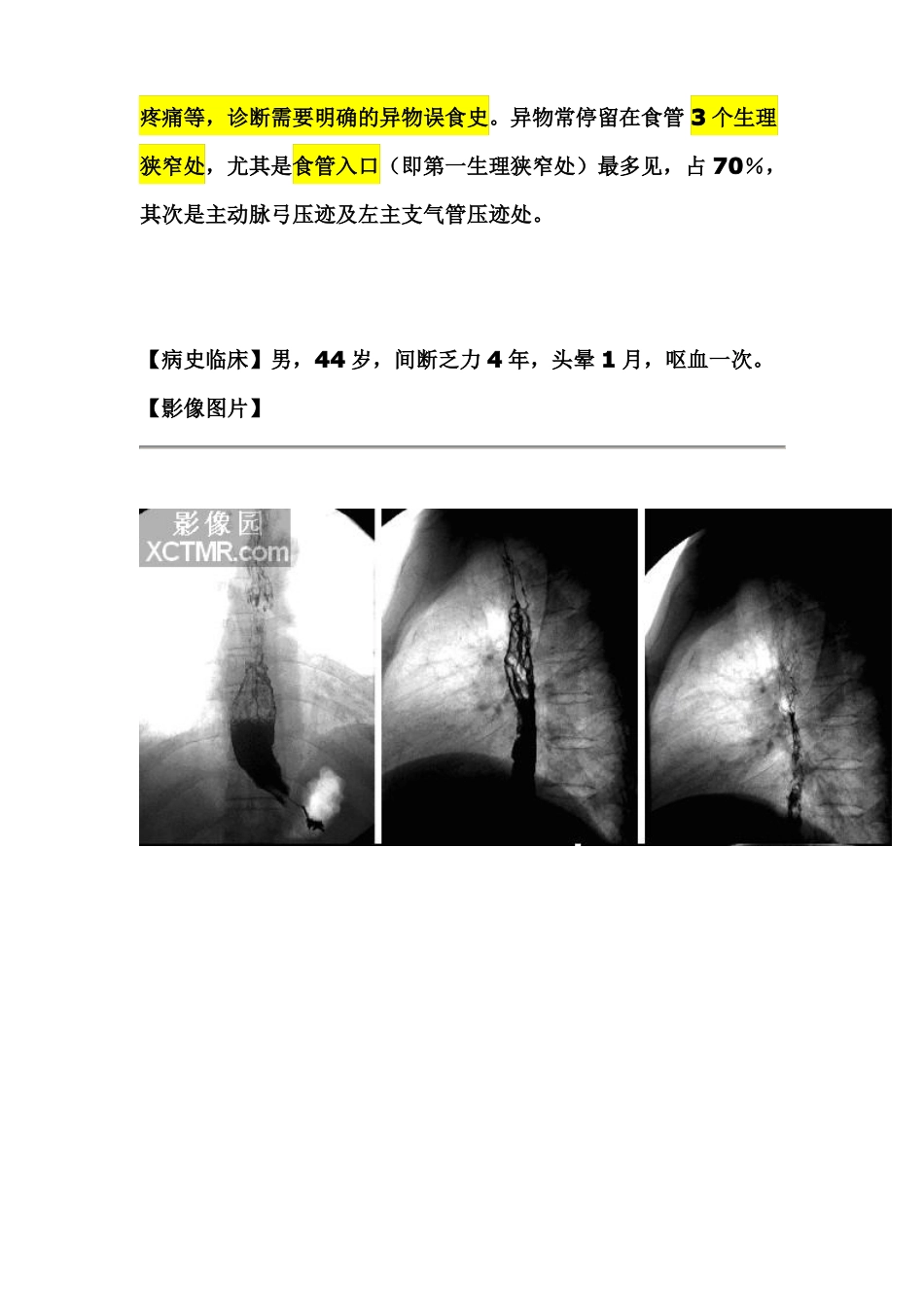 食管异物和气管异物鉴别诊断_第3页